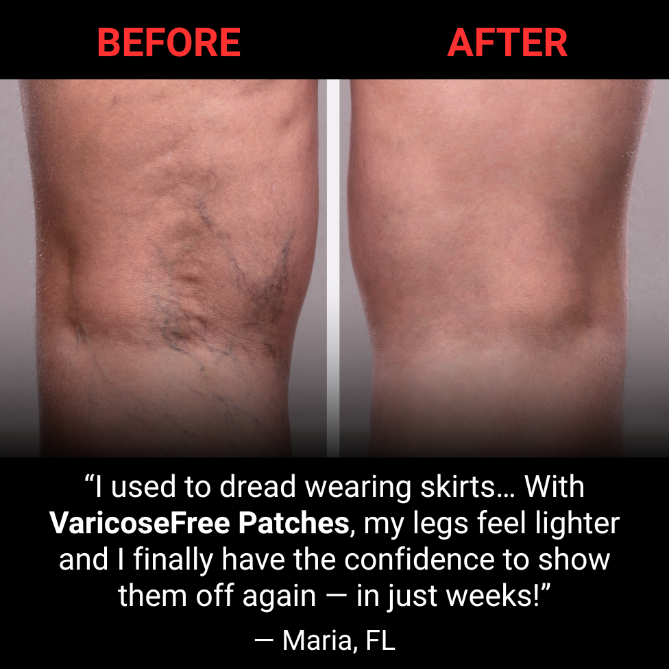 Varicose Free Patches – Ultimate Confidence & Comfort Solution Backed by Ancient Herbal Wisdom