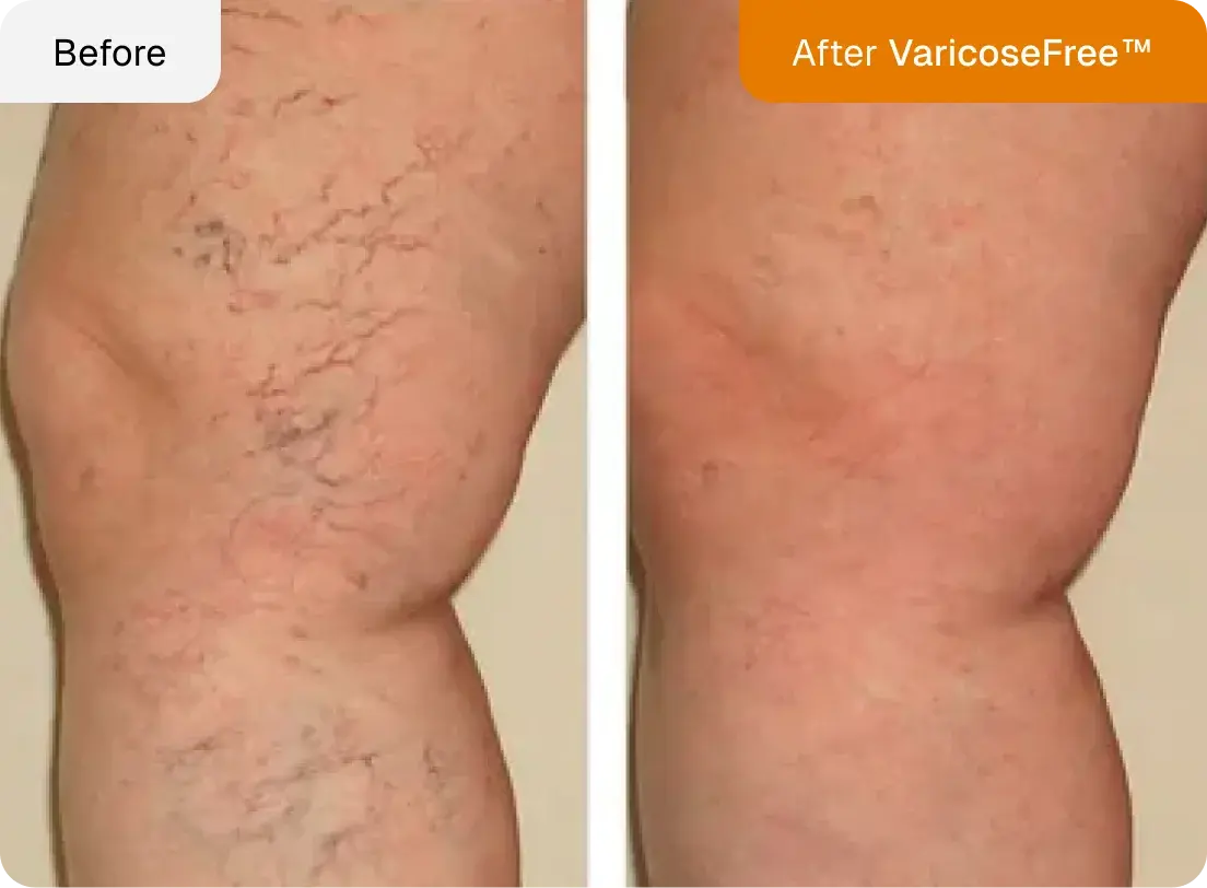 Maximum Potency Anti-Varicose & Spider Vein Patches | VaricoseFree™