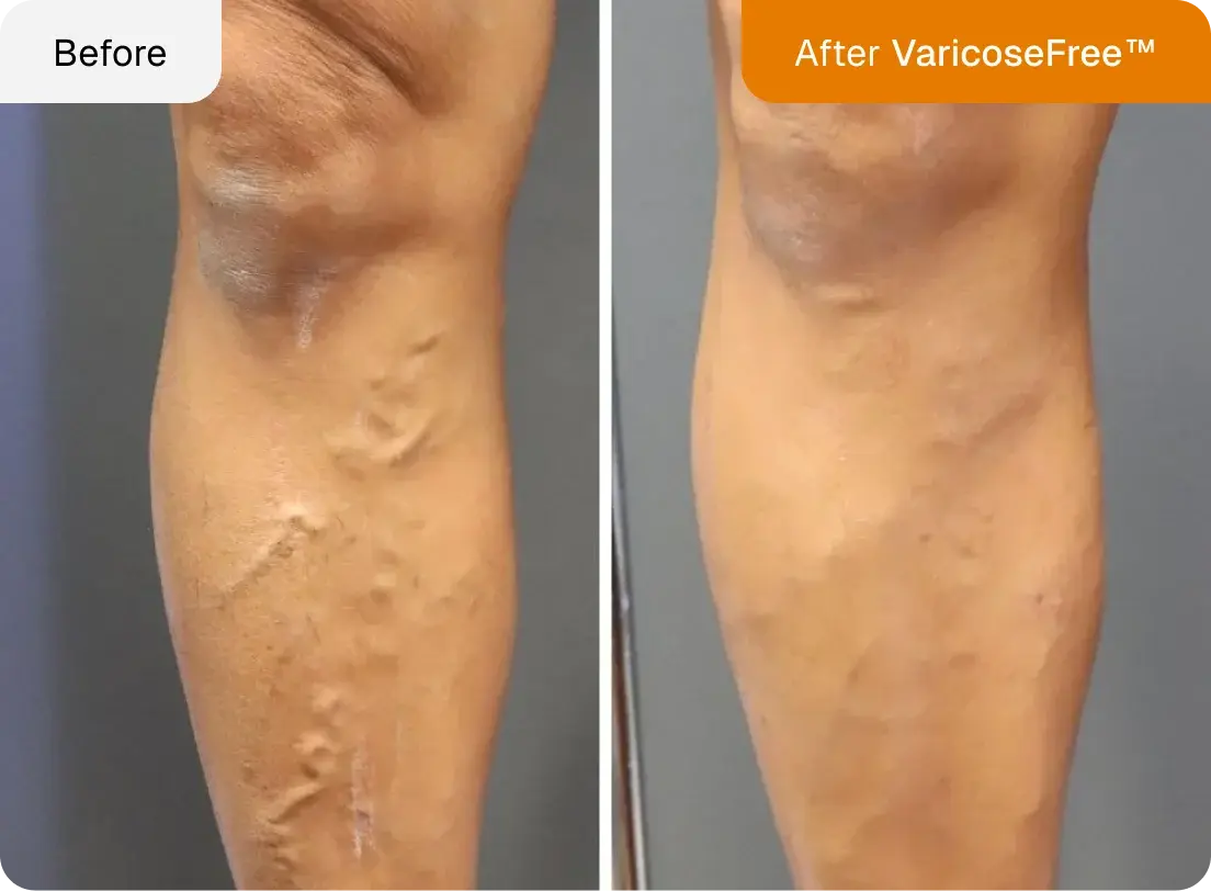 Maximum Potency Anti-Varicose & Spider Vein Patches | VaricoseFree™