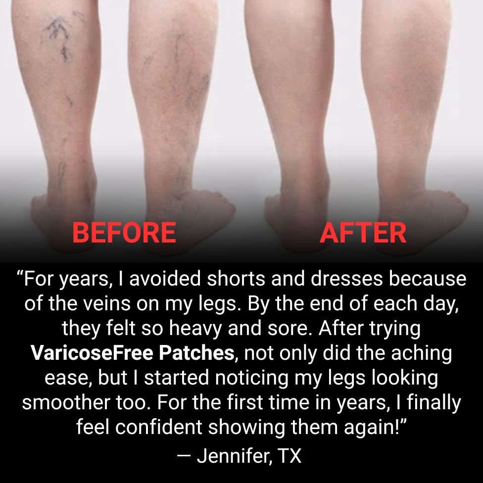 Varicose Free Patches – Ultimate Confidence & Comfort Solution Backed by Ancient Herbal Wisdom