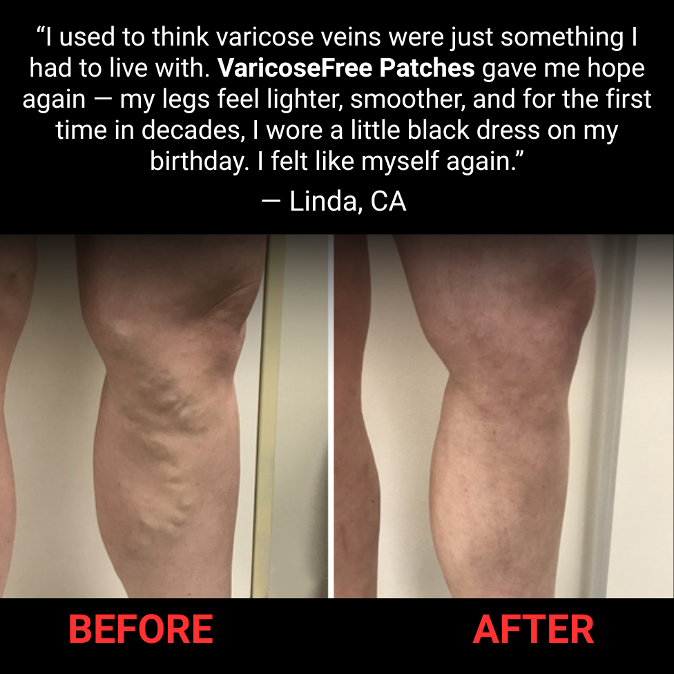 Varicose Free Patches – Ultimate Confidence & Comfort Solution Backed by Ancient Herbal Wisdom