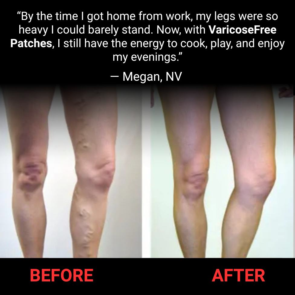 Varicose Free Patches – Ultimate Confidence & Comfort Solution Backed by Ancient Herbal Wisdom