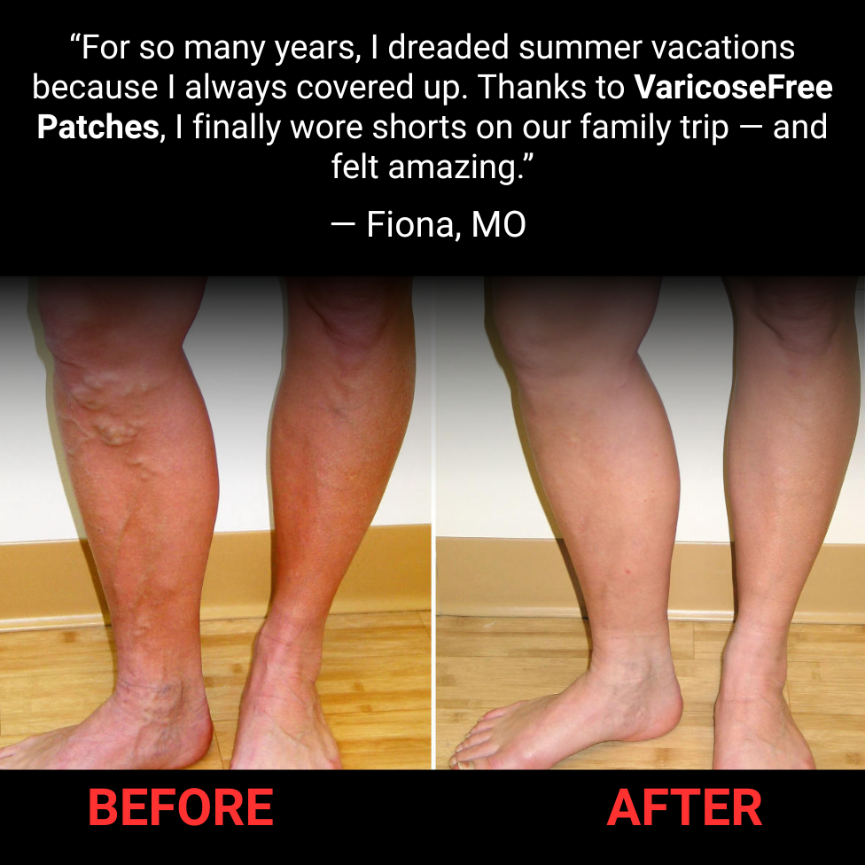 Varicose Free Patches – Ultimate Confidence & Comfort Solution Backed by Ancient Herbal Wisdom