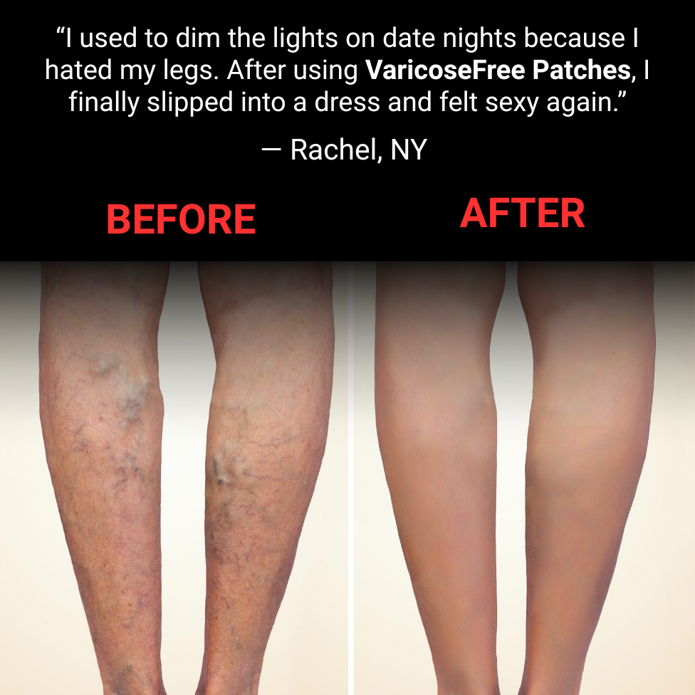 Varicose Free Patches – Ultimate Confidence & Comfort Solution Backed by Ancient Herbal Wisdom