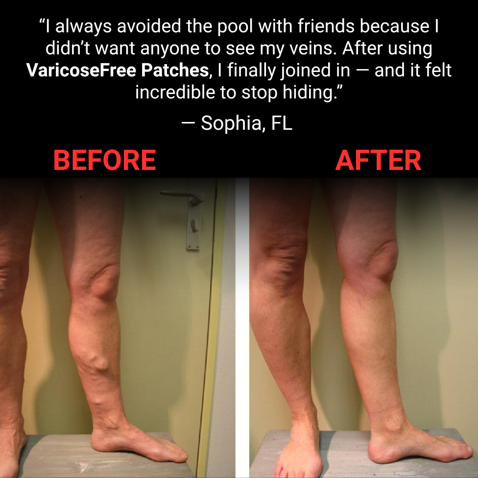 Varicose Free Patches – Ultimate Confidence & Comfort Solution Backed by Ancient Herbal Wisdom